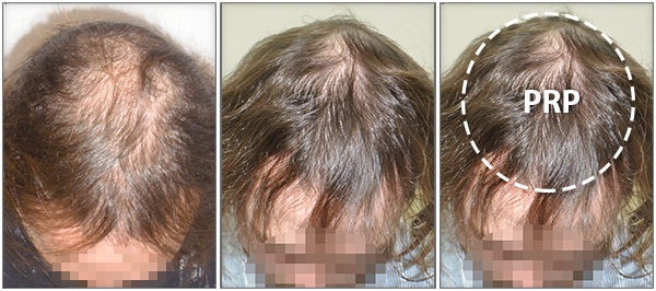 PRP-for-hair-loss-review-great-directions-9-1.png
